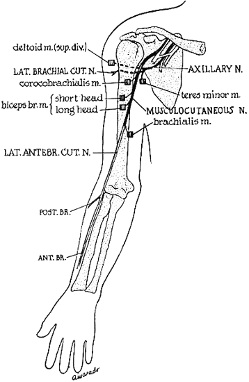 emg sciatic nerve