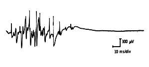 Normal Insertional Activity