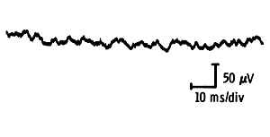 End-plate activity (mono)