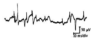 End-plate activity (bi)